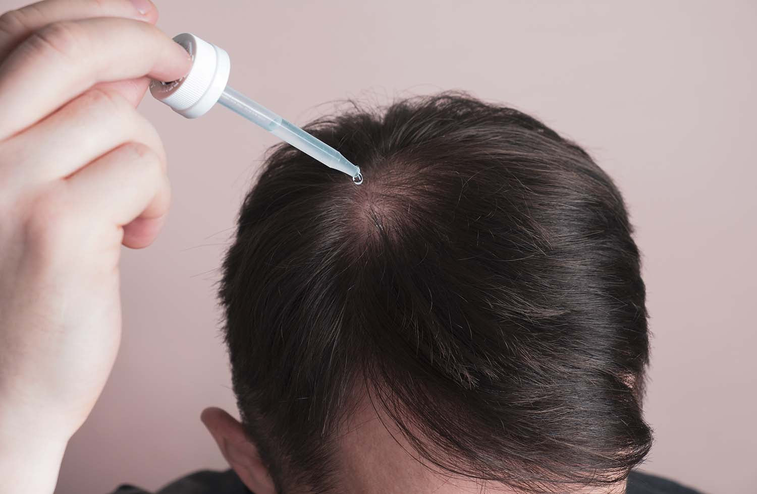 Warum ist die Anwendung von Minoxidil bei Haarausfall gefährlich?
